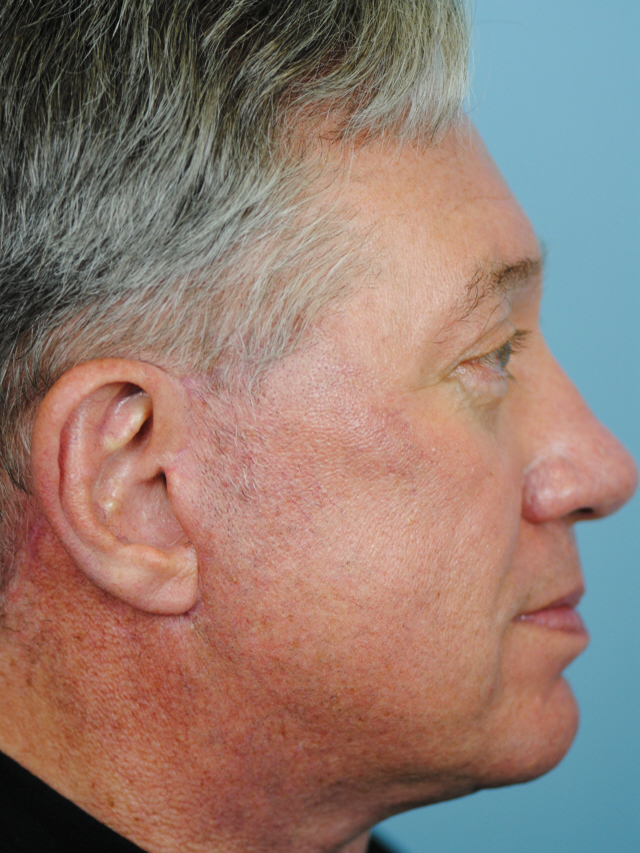 Charleston Custom Lift Facelift Before and After | Thomas Funcik MD