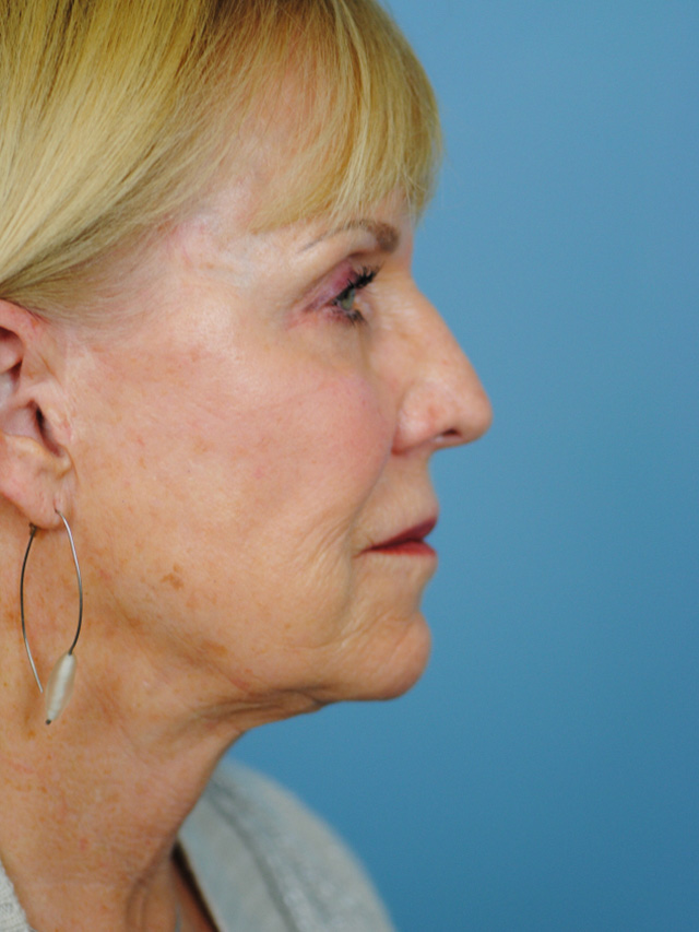 Charleston Custom Lift Facelift Before and After | Thomas Funcik MD