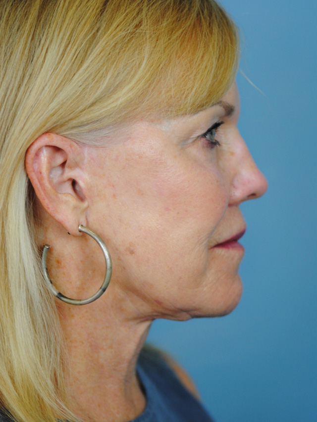 Charleston Custom Lift Facelift Before and After | Thomas Funcik MD