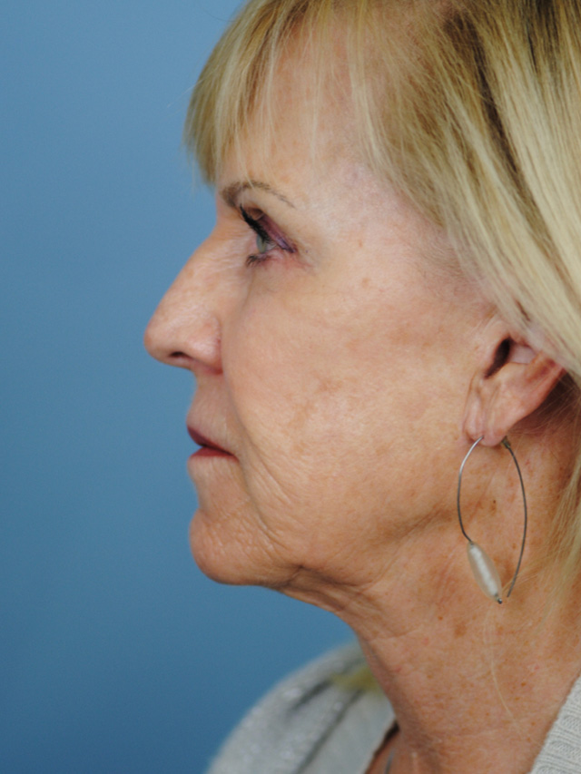 Charleston Custom Lift Facelift Before and After | Thomas Funcik MD