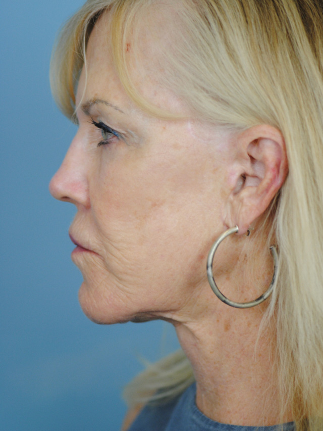 Charleston Custom Lift Facelift Before and After | Thomas Funcik MD