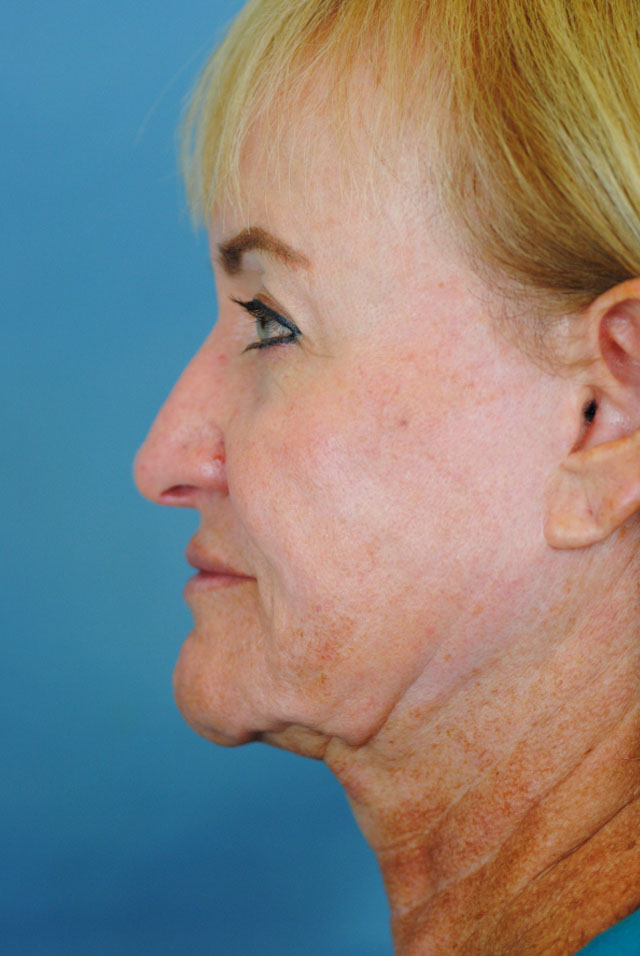 Charleston Custom Lift Facelift Before and After | Thomas Funcik MD