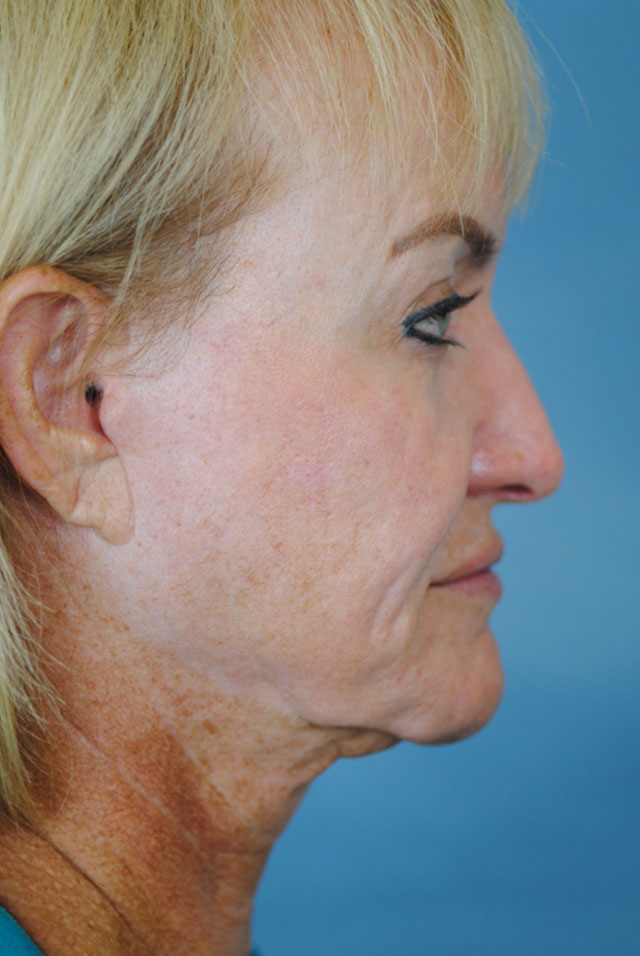 Charleston Custom Lift Facelift Before and After | Thomas Funcik MD