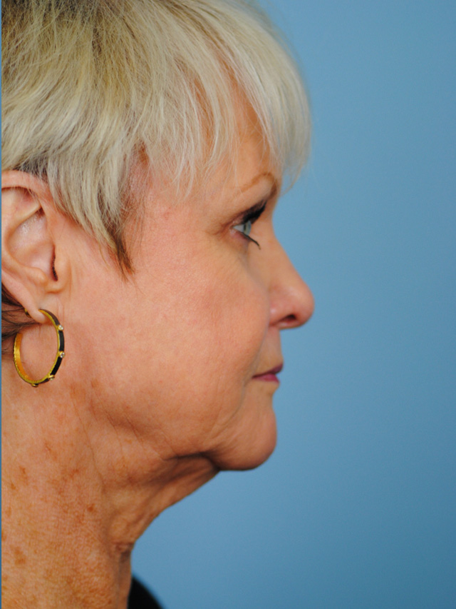 Charleston Custom Lift Facelift Before and After | Thomas Funcik MD