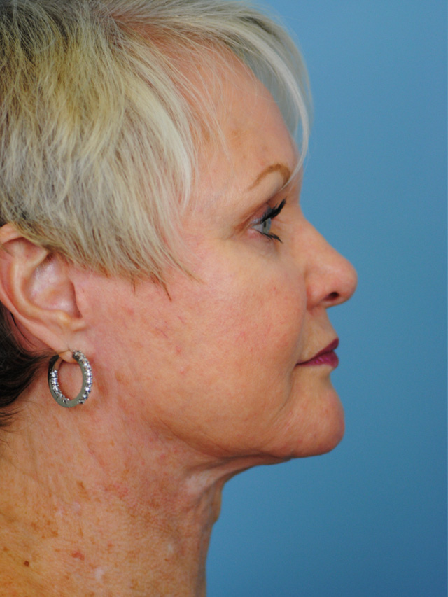 Charleston Custom Lift Facelift Before and After | Thomas Funcik MD