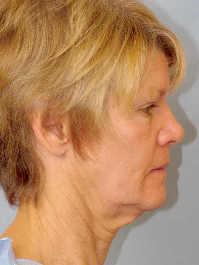 Charleston Custom Lift Facelift Before and After | Thomas Funcik MD