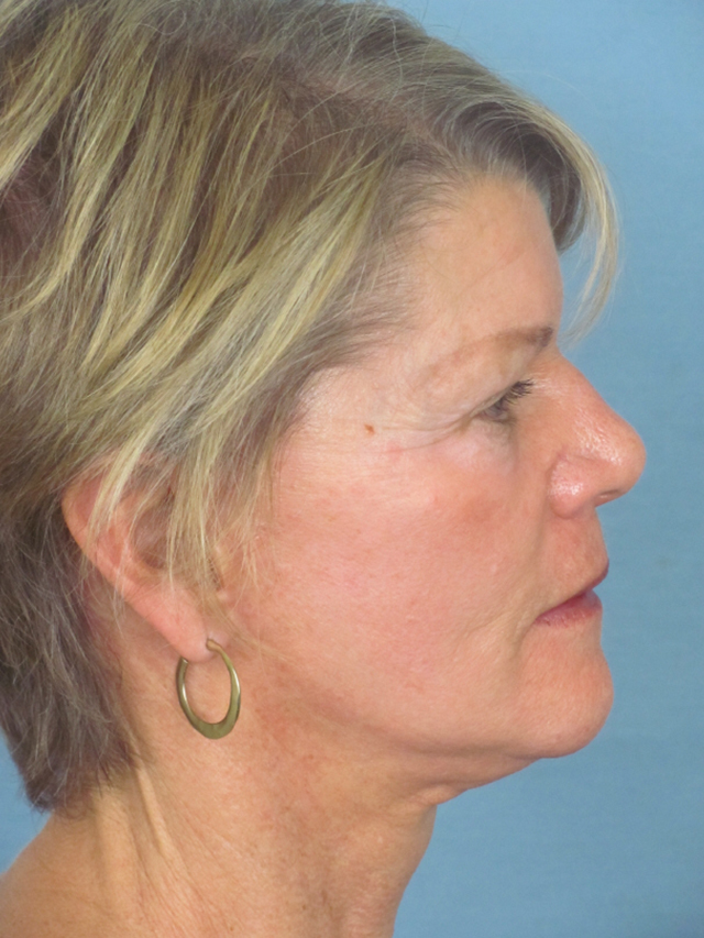 Charleston Custom Lift Facelift Before and After | Thomas Funcik MD