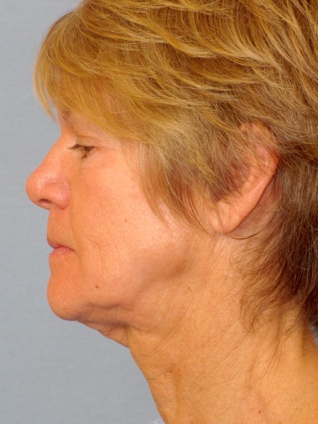 Charleston Custom Lift Facelift Before and After | Thomas Funcik MD