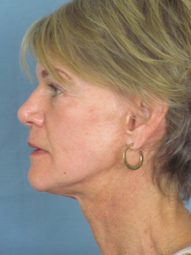 Charleston Custom Lift Facelift Before and After | Thomas Funcik MD