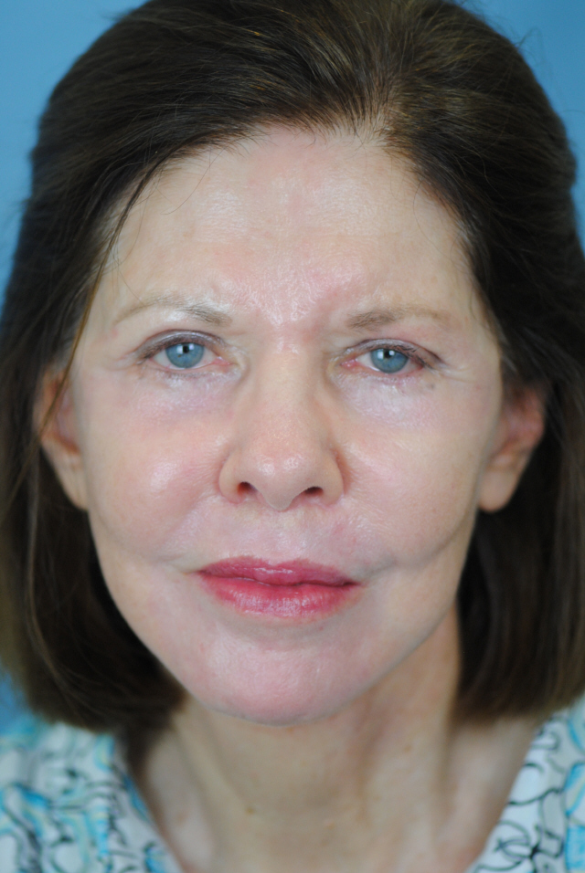 Charleston Custom Lift Facelift Before and After | Thomas Funcik MD