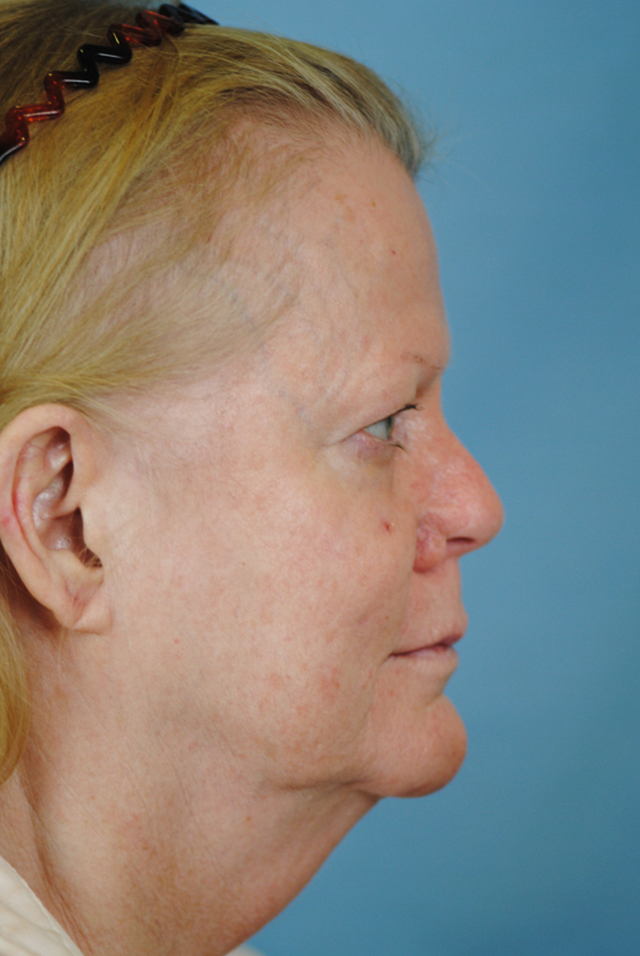 Charleston Custom Lift Facelift Before and After | Thomas Funcik MD