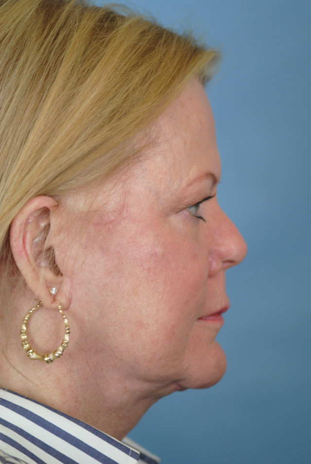 Charleston Custom Lift Facelift Before and After | Thomas Funcik MD