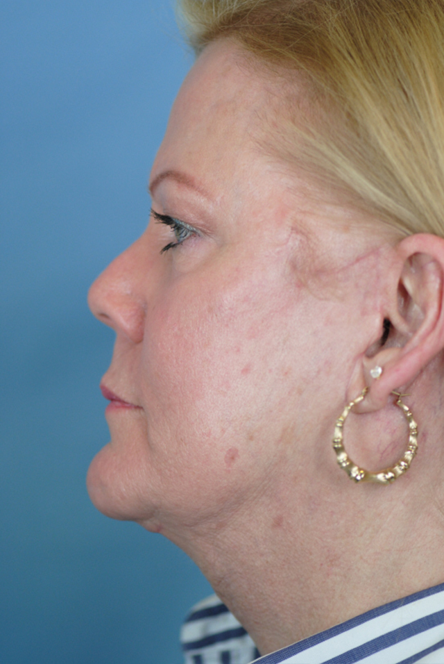 Charleston Custom Lift Facelift Before and After | Thomas Funcik MD