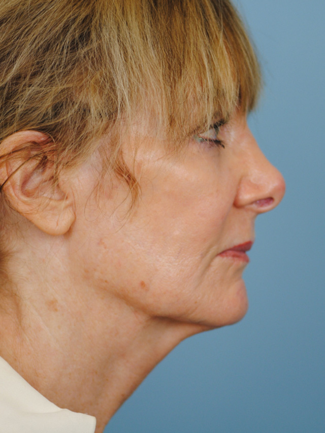 Charleston Custom Lift Facelift Before and After | Thomas Funcik MD