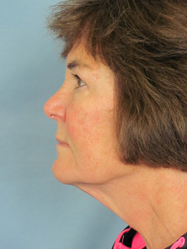 Charleston Custom Lift Facelift Before and After | Thomas Funcik MD