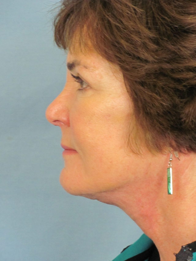 Charleston Custom Lift Facelift Before and After | Thomas Funcik MD