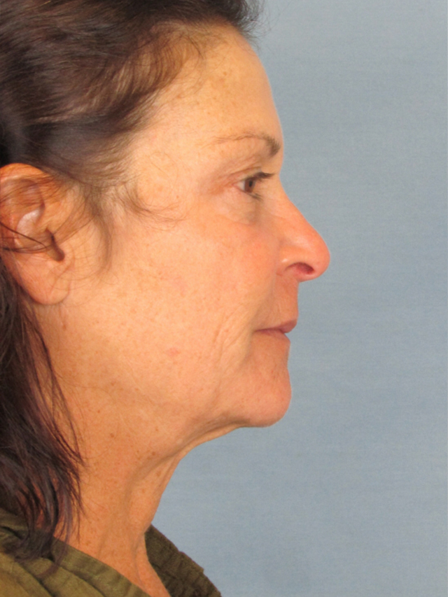 Charleston Custom Lift Facelift Before and After | Thomas Funcik MD