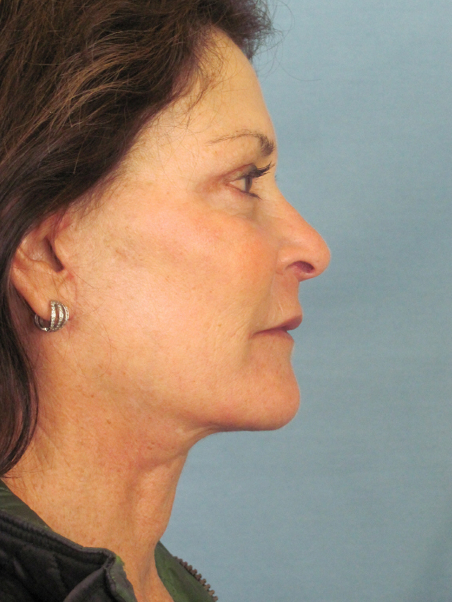 Charleston Custom Lift Facelift Before and After | Thomas Funcik MD