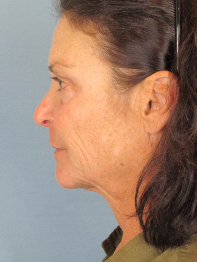 Charleston Custom Lift Facelift Before and After | Thomas Funcik MD