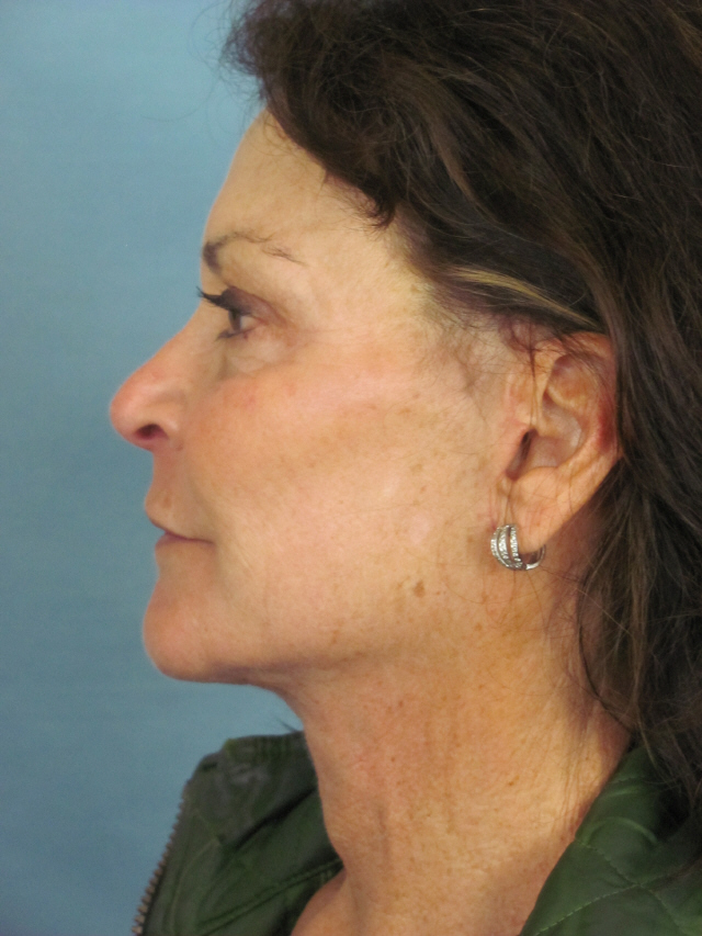 Charleston Custom Lift Facelift Before and After | Thomas Funcik MD