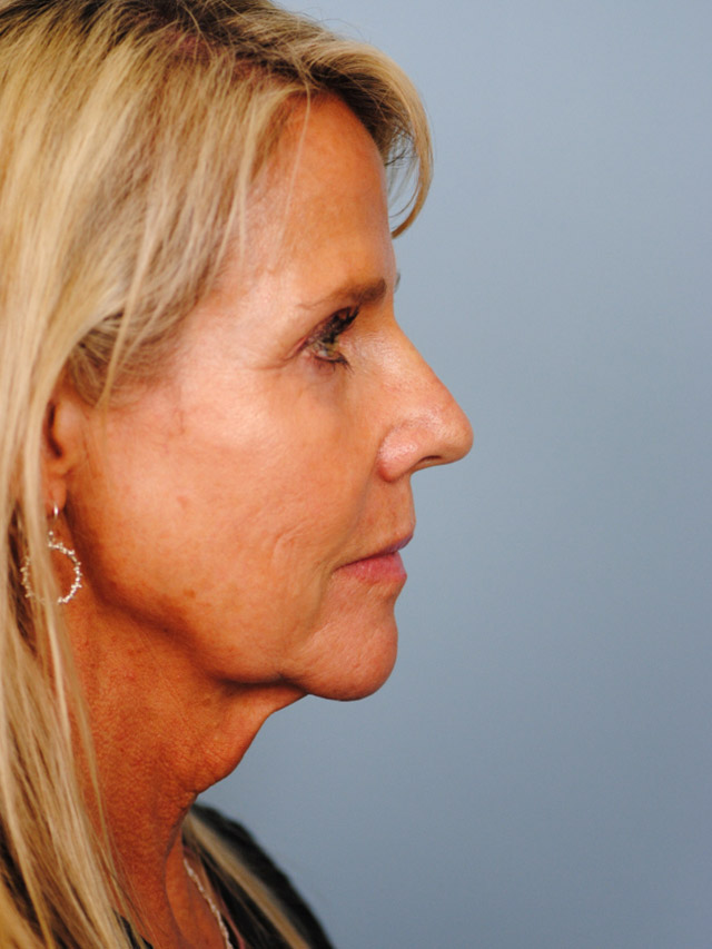 Charleston Custom Lift Facelift Before and After | Thomas Funcik MD