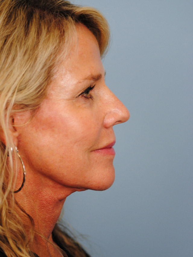 Charleston Custom Lift Facelift Before and After | Thomas Funcik MD