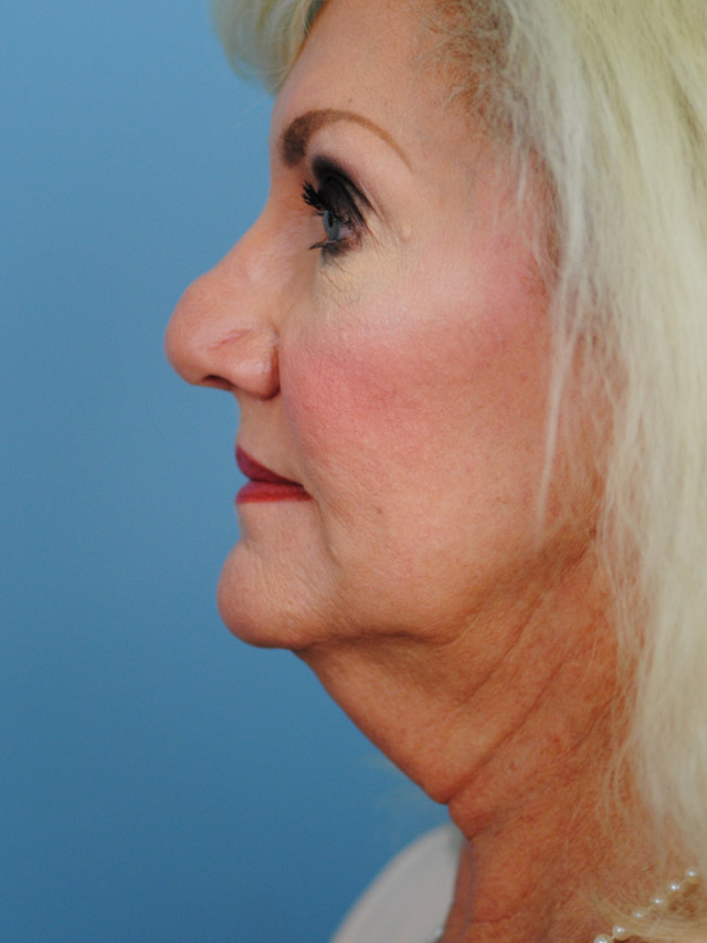 Charleston Custom Lift Facelift Before and After | Thomas Funcik MD