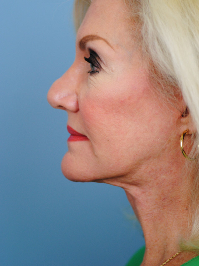 Charleston Custom Lift Facelift Before and After | Thomas Funcik MD