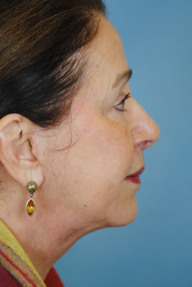 Charleston Custom Lift Facelift Before and After | Thomas Funcik MD