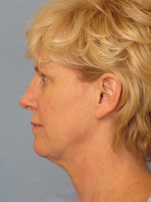 Charleston Custom Lift Facelift Before and After | Thomas Funcik MD