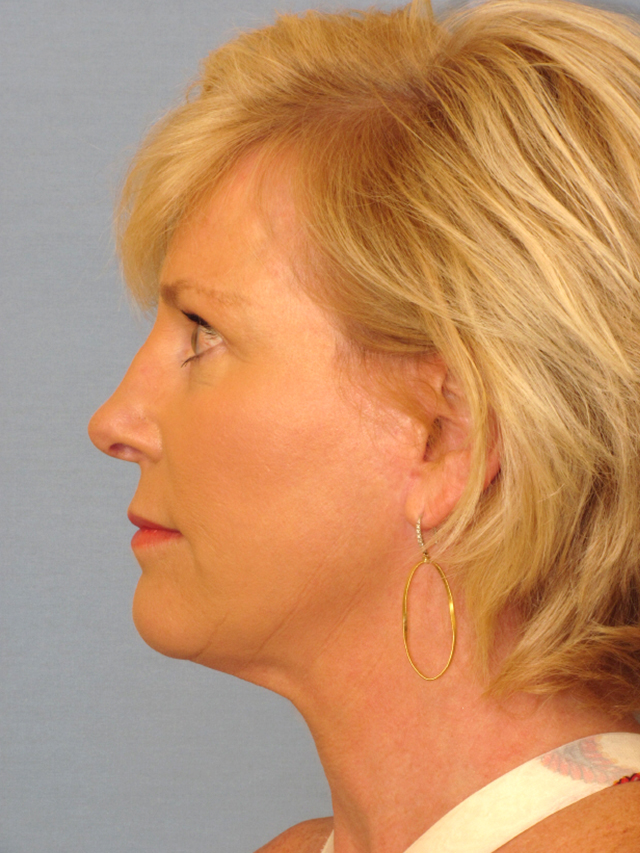 Charleston Custom Lift Facelift Before and After | Thomas Funcik MD