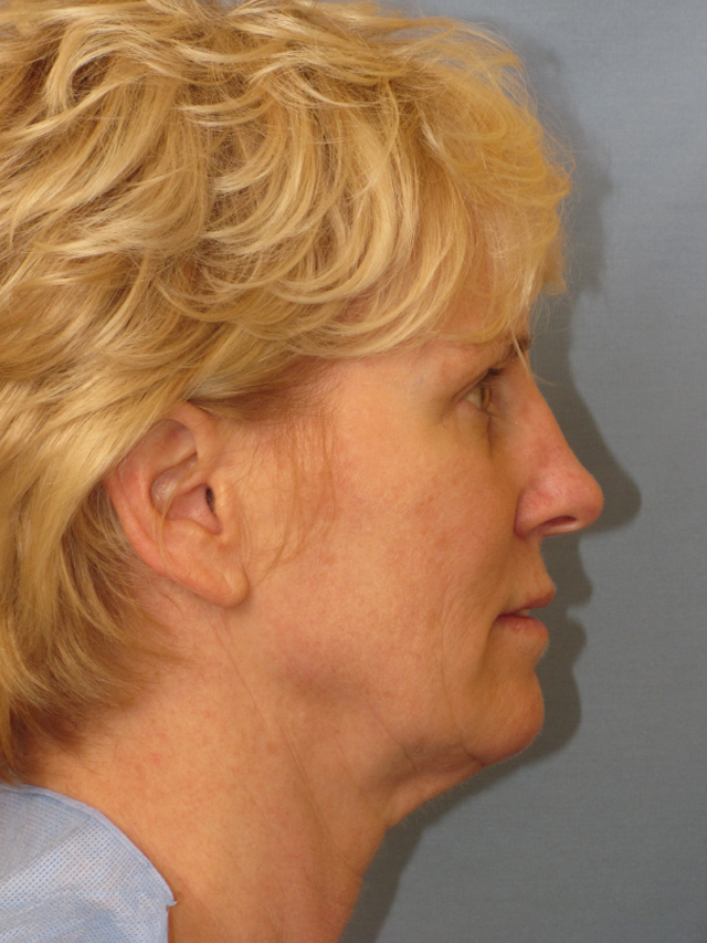 Charleston Custom Lift Facelift Before and After | Thomas Funcik MD