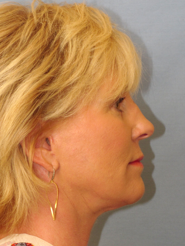 Charleston Custom Lift Facelift Before and After | Thomas Funcik MD