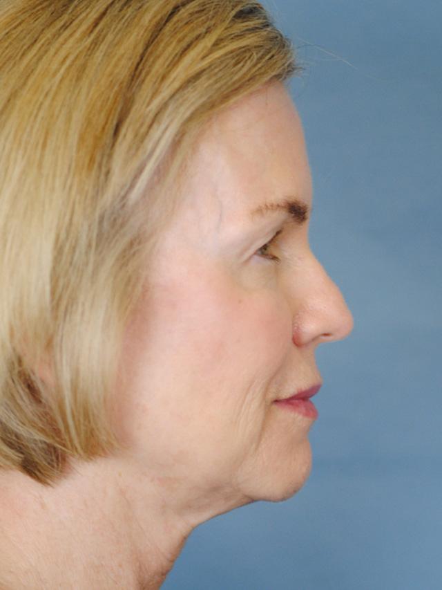 Charleston Custom Lift Facelift Before and After | Thomas Funcik MD