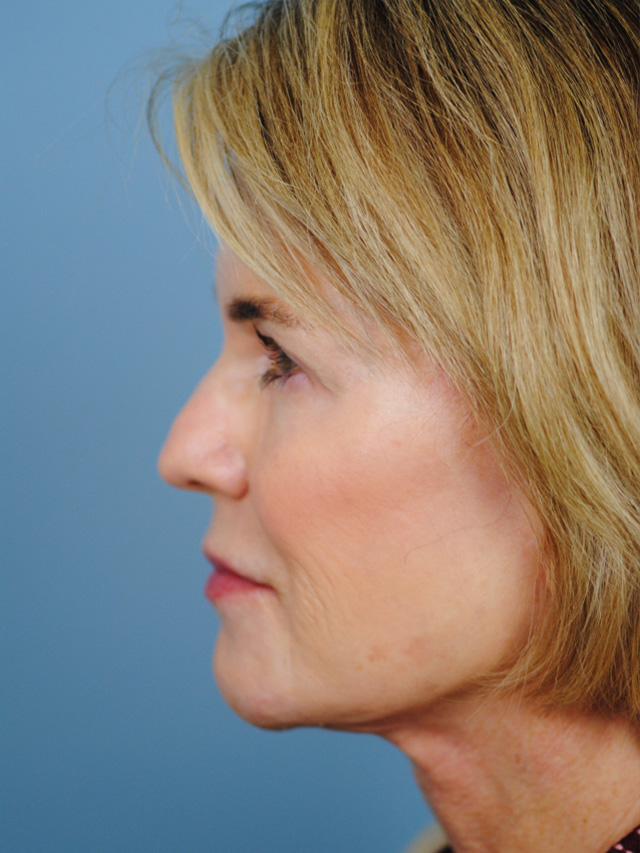 Charleston Custom Lift Facelift Before and After | Thomas Funcik MD