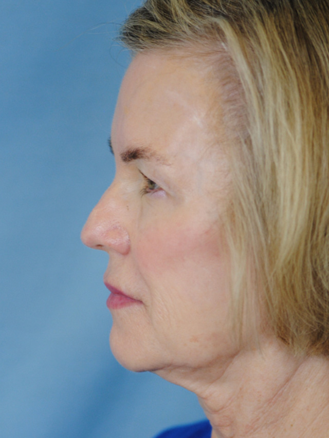 Charleston Custom Lift Facelift Before and After | Thomas Funcik MD