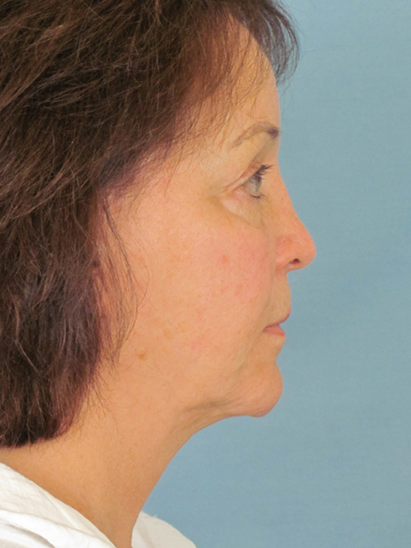 Charleston Custom Lift Facelift Before and After | Thomas Funcik MD