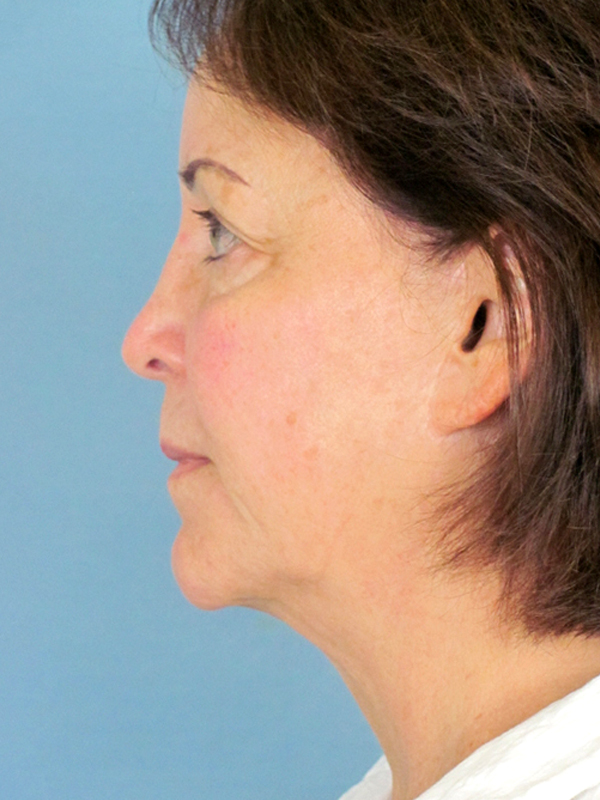 Charleston Custom Lift Facelift Before and After | Thomas Funcik MD