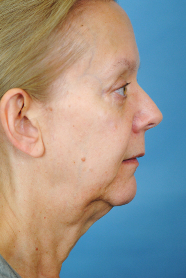 Charleston Custom Lift Facelift Before and After | Thomas Funcik MD