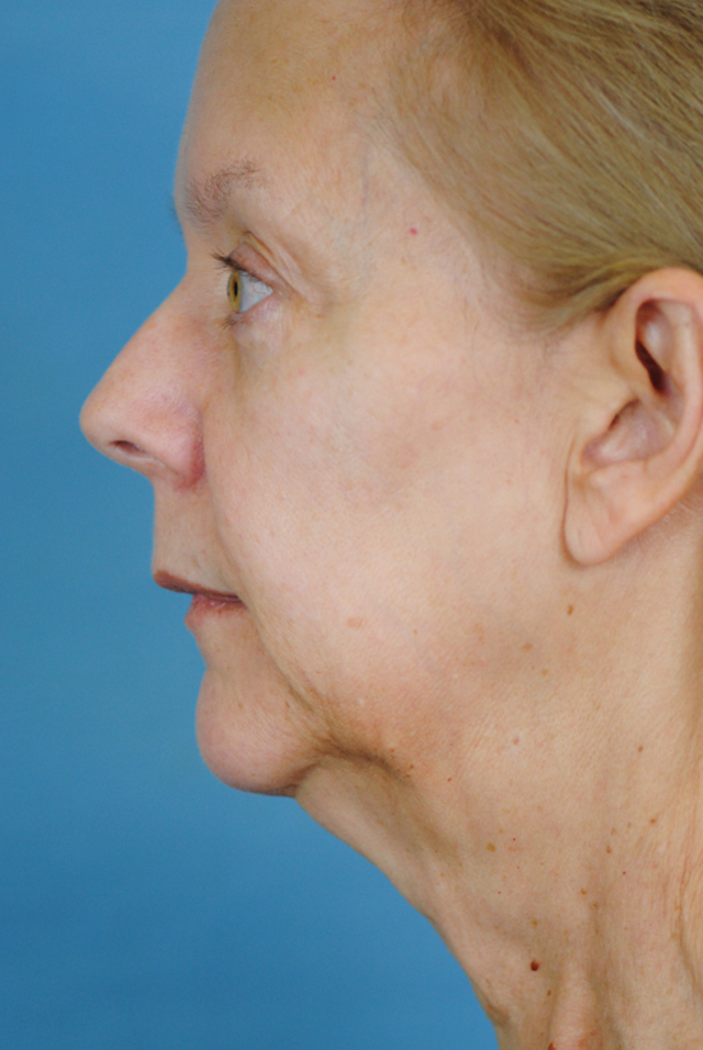 Charleston Custom Lift Facelift Before and After | Thomas Funcik MD