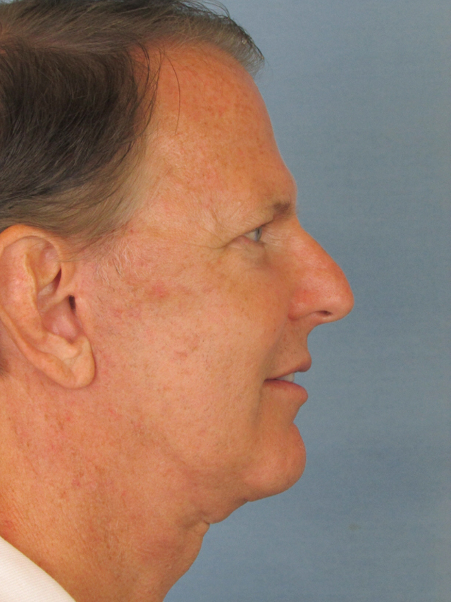 Charleston Custom Lift Facelift Before and After | Thomas Funcik MD