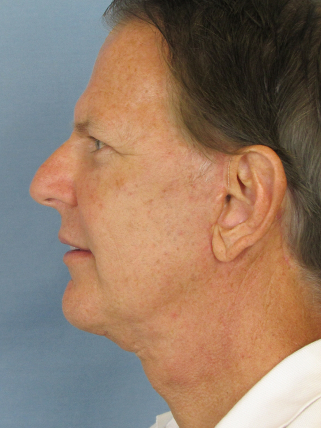 Charleston Custom Lift Facelift Before and After | Thomas Funcik MD