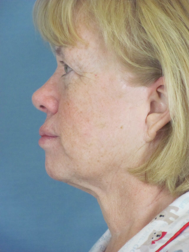 Charleston Custom Lift Facelift Before and After | Thomas Funcik MD