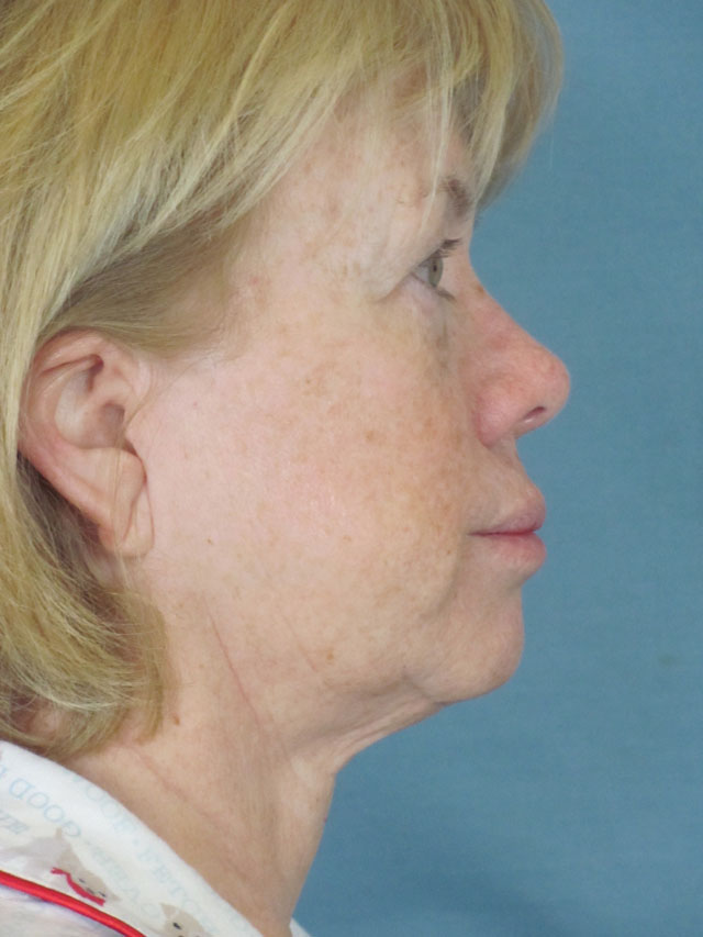 Charleston Custom Lift Facelift Before and After | Thomas Funcik MD