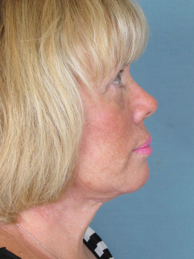 Charleston Custom Lift Facelift Before and After | Thomas Funcik MD