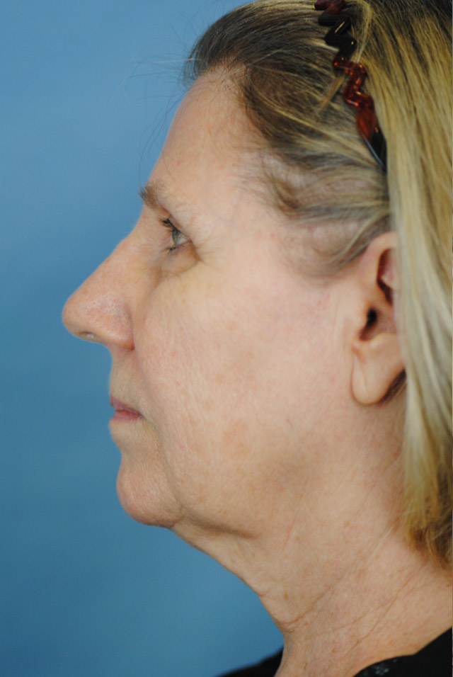 Charleston Custom Lift Facelift Before and After | Thomas Funcik MD