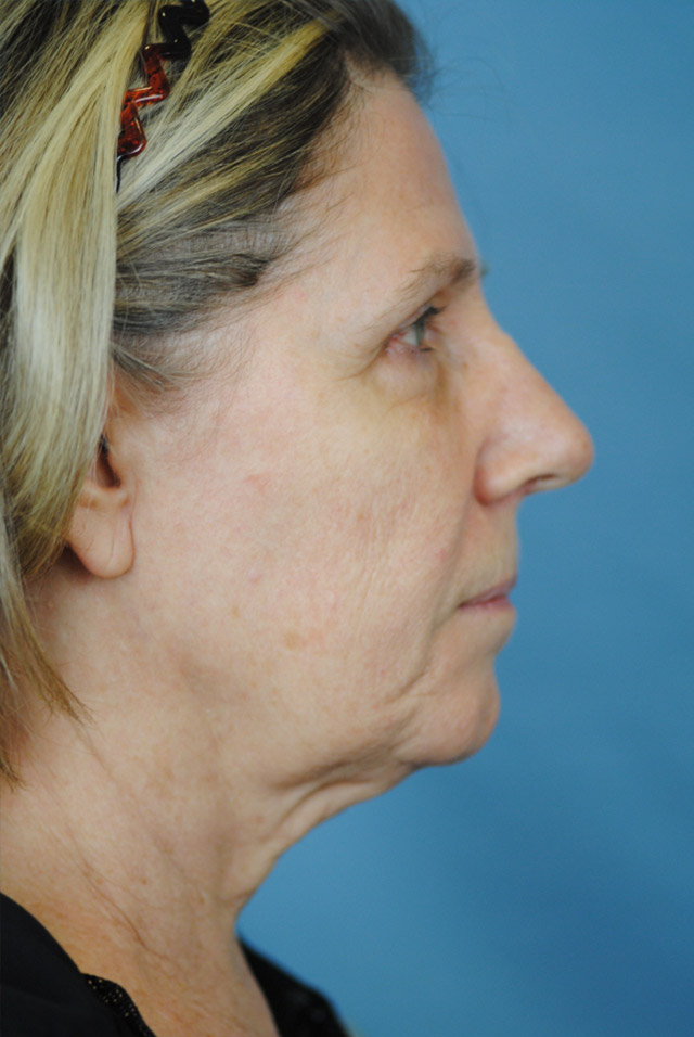 Charleston Custom Lift Facelift Before and After | Thomas Funcik MD