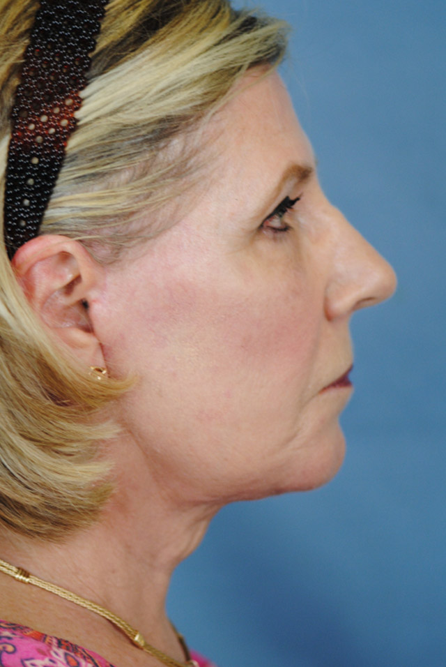 Charleston Custom Lift Facelift Before and After | Thomas Funcik MD