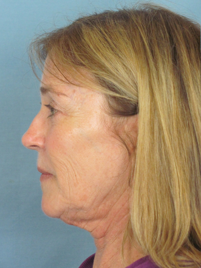 Charleston Custom Lift Facelift Before and After | Thomas Funcik MD