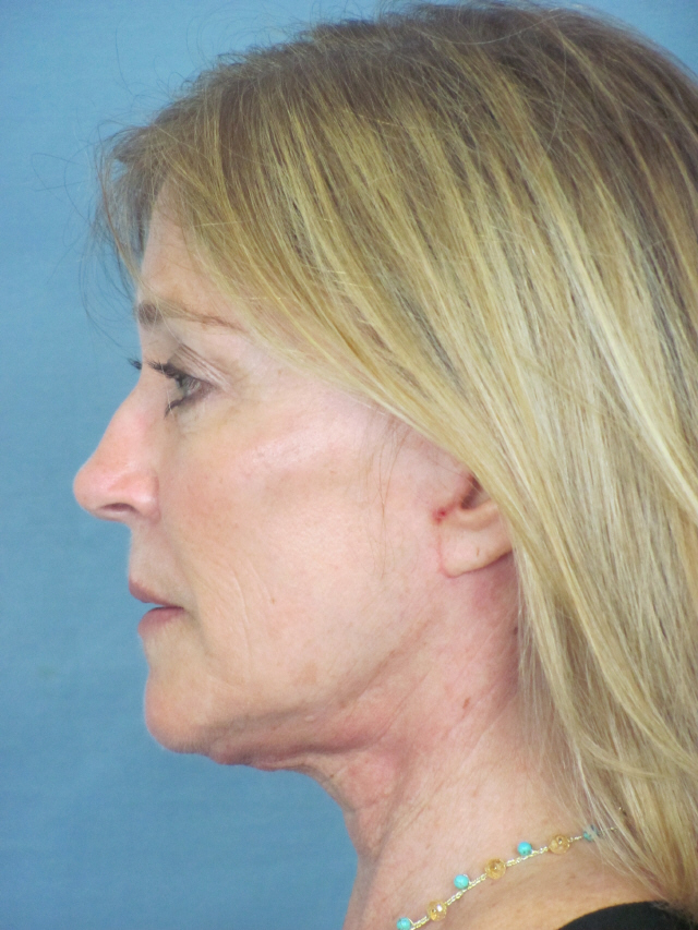 Charleston Custom Lift Facelift Before and After | Thomas Funcik MD